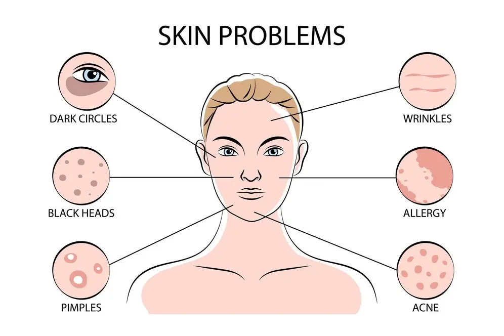 Dark Circle Home Remedies